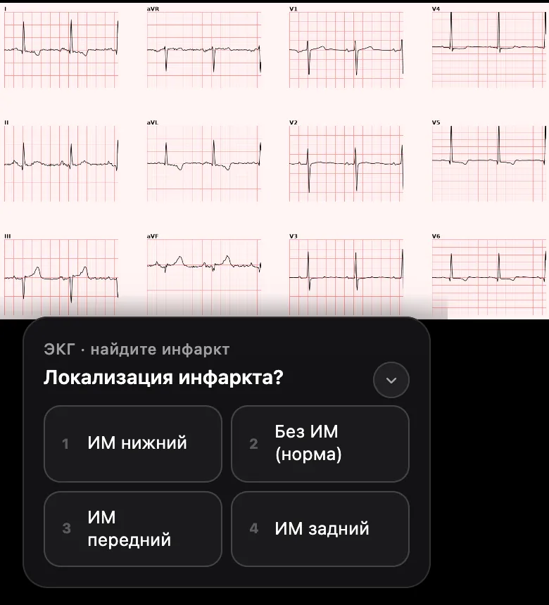 Лента тренажёра ЭКГ: 12 отведений и вопрос «Локализация инфаркта?» с четырьмя вариантами ответа